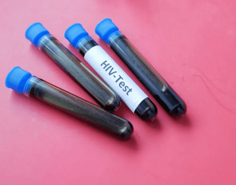 Alarmujący wzrost zakażeń HIV w Małopolsce – sanepid wskazuje na związek z uchodźcami z Ukrainy